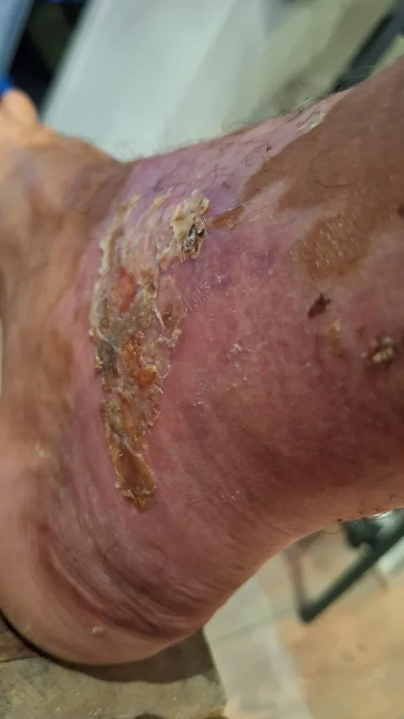 Stefan's ankle, nearly recovered.